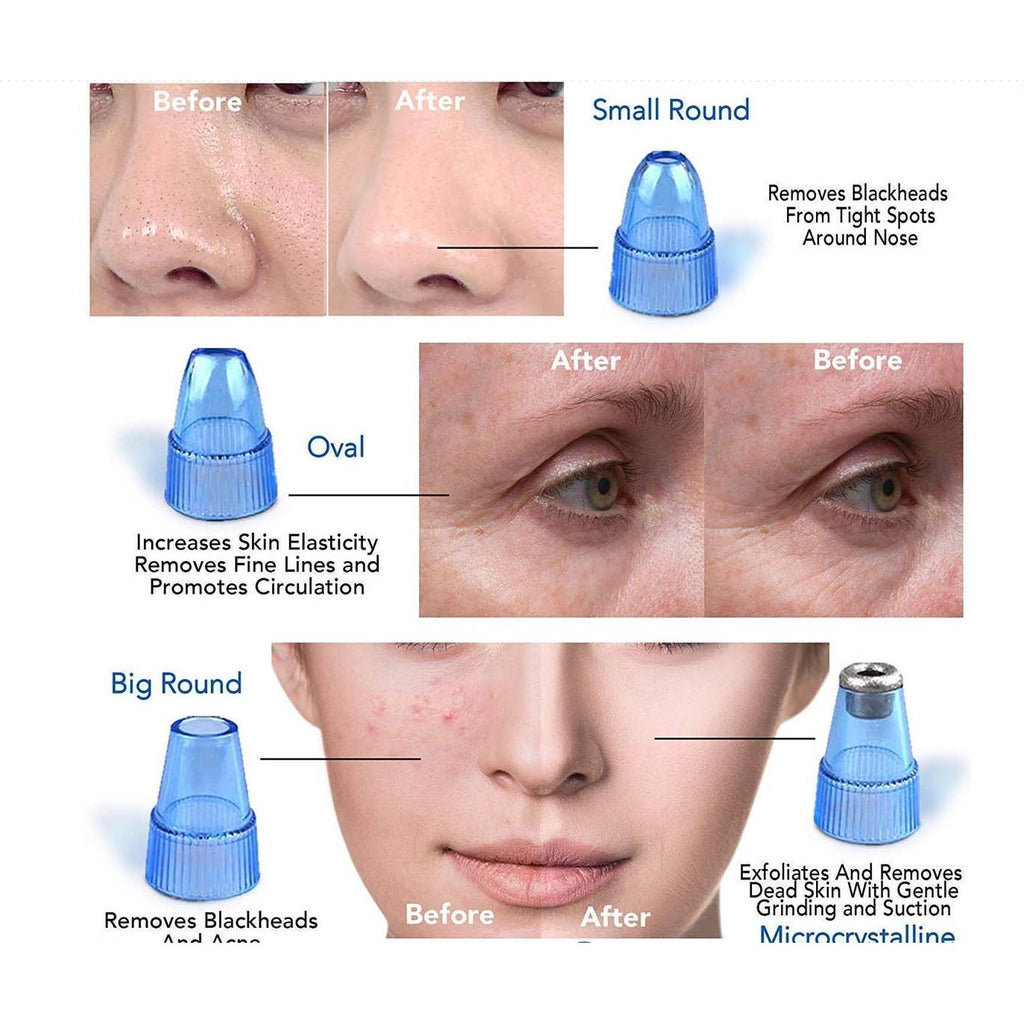 4 in 1 blackhead remover product image 3